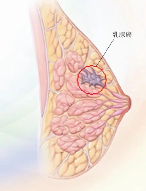 乳腺癌症的早期信号_最佳精选